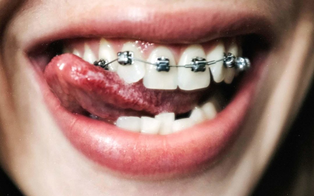Jak i czym myć zęby z aparatem ortodontycznym?